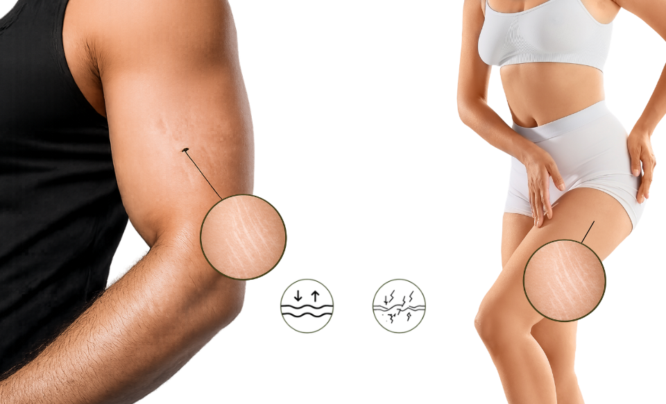 Imagem provisória — regiões do corpo propensas a estrias